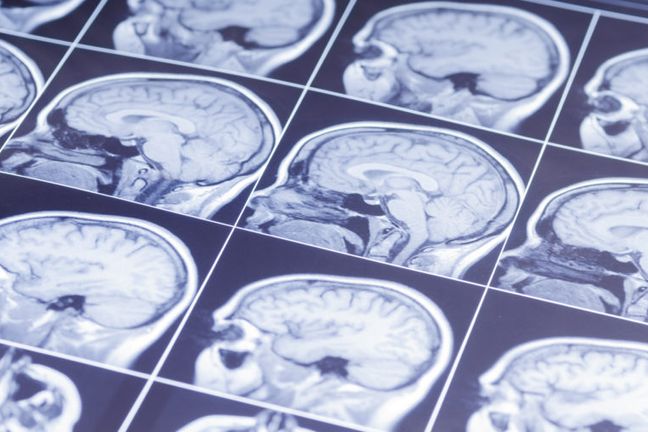 Defending the Mild Traumatic Brain Injury Case in California